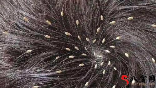 Dreaming of a child with many lice on his head