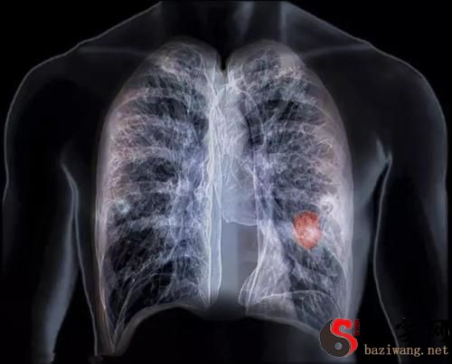 Dreaming of lung cancer