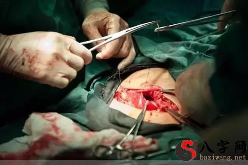 Dreaming of giving birth by caesarean section