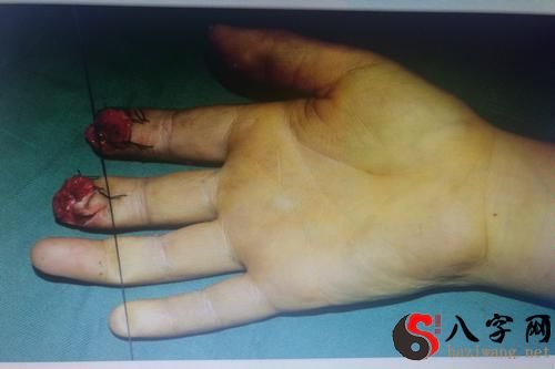 I dreamt that my finger was broken and bleeding.