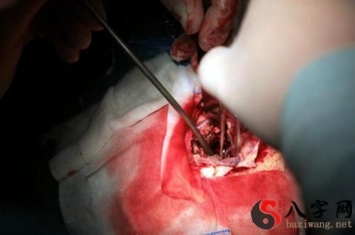 Dreaming of bleeding from an operation