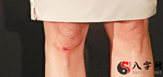 Dreaming of bleeding legs