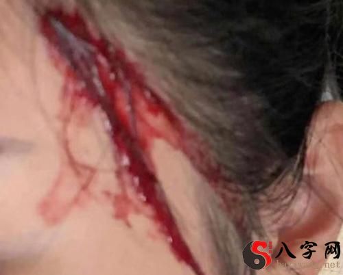 I dreamed of bleeding on my forehead in the street.