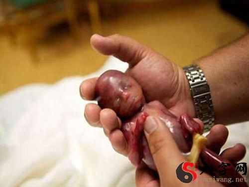 Dreaming of a pregnancy followed by a miscarriage