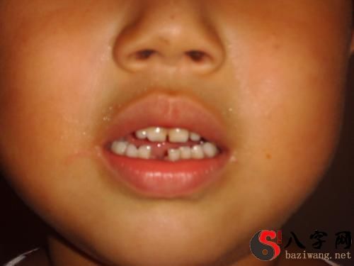 Dreaming of losing teeth and bleeding